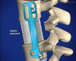 Lumbar Corpectomy and Fusion - Neurosurgery and Spine Surgery ...