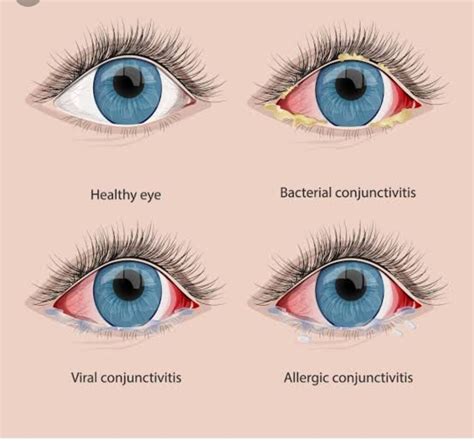 Conjunctivitis - pinkeye, Children get it a lot - Santripty