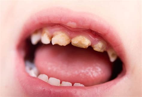 Dental caries breakthrough - Bite Magazine