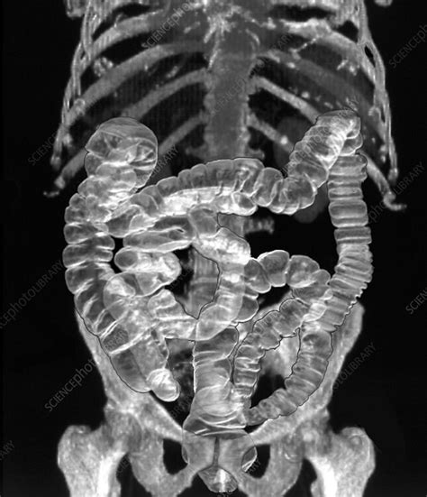 Normal intestines, 3D CT scan - Stock Image P560/0187 - Science Photo Library