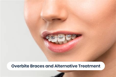 A Complete Guide to Overbite Braces