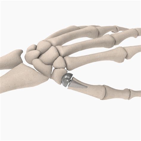 CMC Joint Replacement - The BioPro Modular Thumb Implant