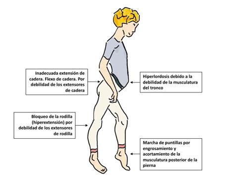 Distrofia muscular de Duchenne – centro activa || especialistas en ...