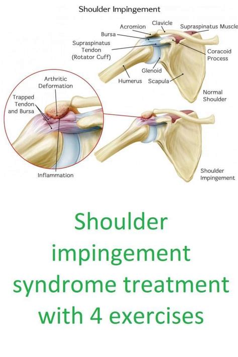 Shoulder impingement cause and treatment with 4 exercises