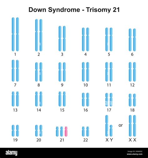 Scientific Designing of Down Syndrome (Trisomy 21) Karyotype. Colorful Symbols. Vector ...