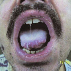 frictional keratosis on tongue