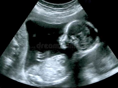 Ultrasound of Baby in Mother S Womb Stock Image - Image of medical, fatherhood: 68836727