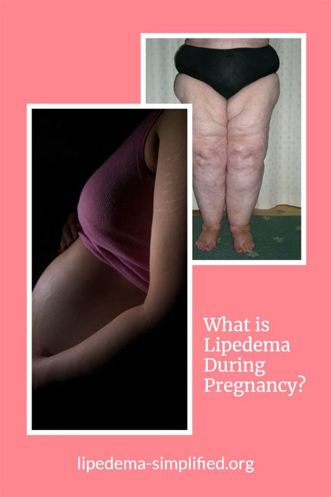 Pin on June: Lipedema Awareness Month