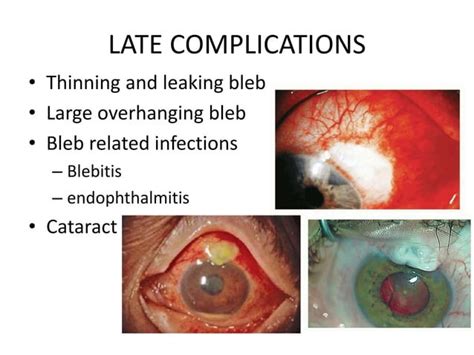 Complications of trabeculectomy