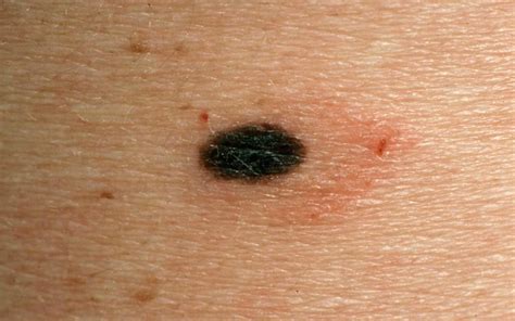 Moles - Causes, Types, Abnormal, Cancerous Moles