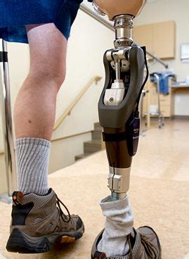 Above Knee Prosthetics - Thompson's Custom Orthotics & Prosthetics | Washington