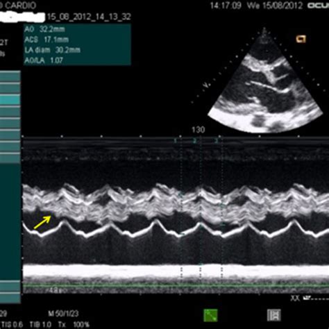 TM-mode transthoracic echocardiography. TAPSE = 19,9 mm (correct right... | Download Scientific ...