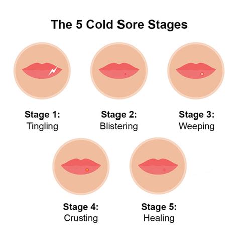 The 5 Cold Sore Stages: A Step-by-Step Guide – Luminance RED