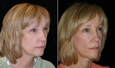 Mini Facelift - 54YO Female Patient - Aesthetica Cosmetic Surgery and Laser Center