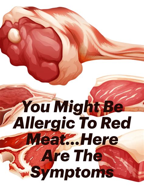 Pin on Alpha-gal | red meat and mammal food allergy