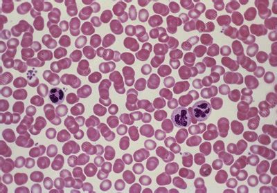 LM of human red blood cells & neutrophils - Stock Image - P242/0107 - Science Photo Library