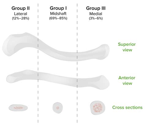 Allman Classification Of Clavicle Fracture