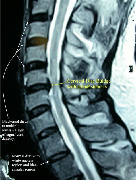 Prolapsed cervical disk (intervertebral disc pathology): nucleus ...