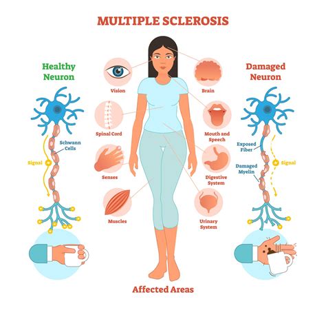 Symptoms of Multiple Sclerosis You Can't See - Sheltering Arms®