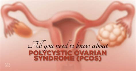 All you need to know about Polycystic Ovarian Syndrome (PCOS) | MR