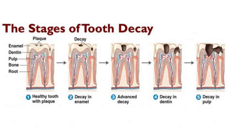 Tooth Decay Causes, Symptoms, Diagnosis & Treatment| Lavanya Dental Clinic