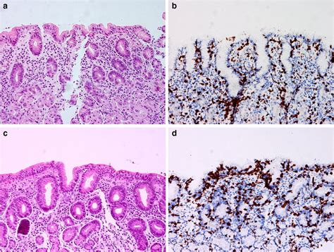 Gastric body and antrum biopsies demonstrating antral predominant ...