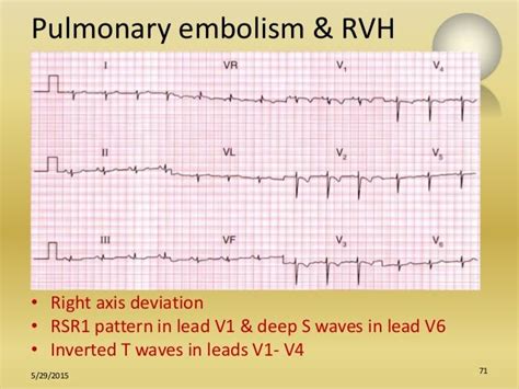 Role of ecg in pulmonology