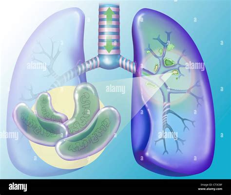 Tuberculosis Drawing