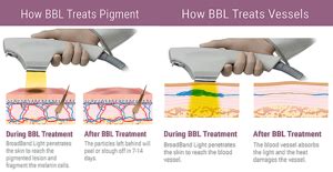 BBL vs. IPL • LA Longevity