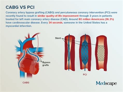 #ESCCongress: Care este tratamentul potrivit după un infarct miocardic: bypass-ul sau ...