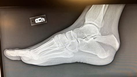 Case Report of a Tongue-Type Calcaneal Fracture - JETem