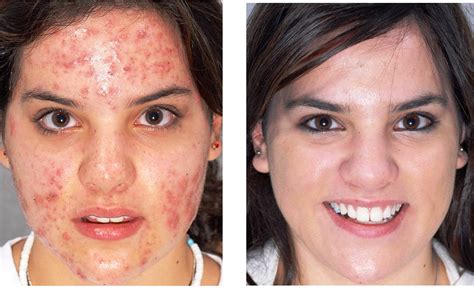 TIMES UPDATE: MESSAGE FOR ALL: DANGERS INHERENT IN SQUEEZING PIMPLES FROM YOUR FACE/SKIN