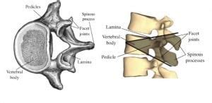 Pedicle Subtraction Osteotomy - Dr. Paul C. McCormick