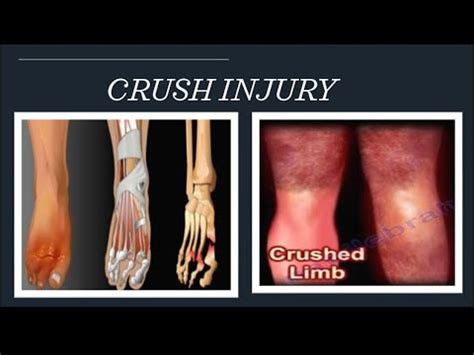 Crush injury| Crush syndrome causes and treatment - YouTube