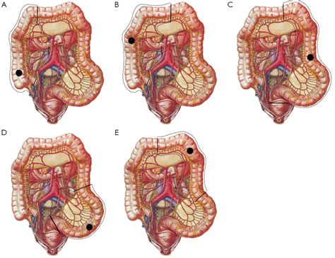 Diagnosis and management of acute complications in patients with colon cancer: bleeding ...