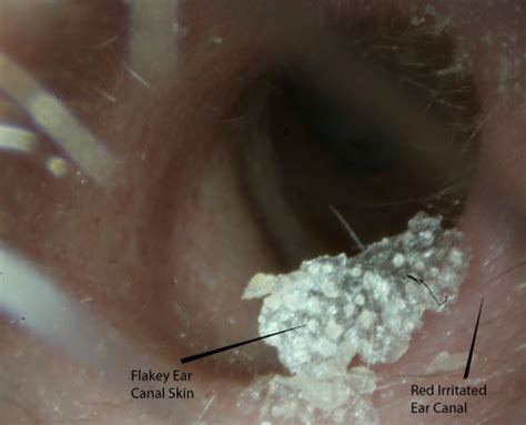 Itchy Ears | McGovern Medical School