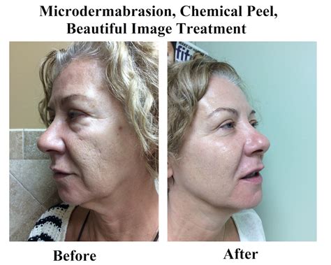 Microdermabrasion, Chemical Peel, Beautiful Image Treatment Before and After | Skin Essence A ...