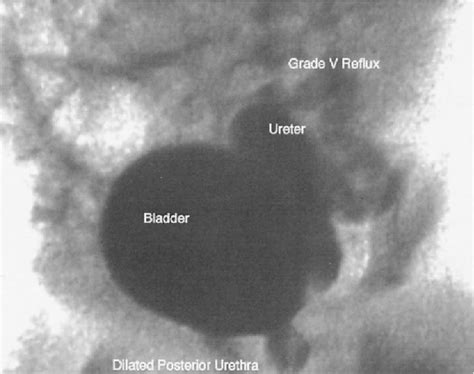 Ureterostomy Tube