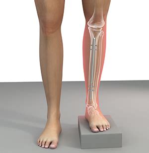 Scanogram Leg Length Discrepancy