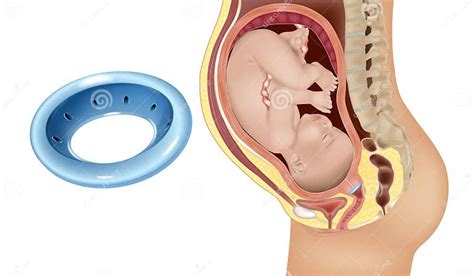 Gynecological and Obstetric Pessary. Cervical Pessary in Pregnant Women ...