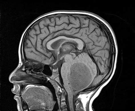 Pilocytic astrocytoma | Radiology Reference Article | Radiopaedia.org