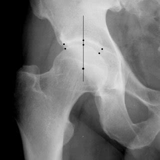 Supine AP X-ray of the right hip joint with a non-displaced subcapital ...