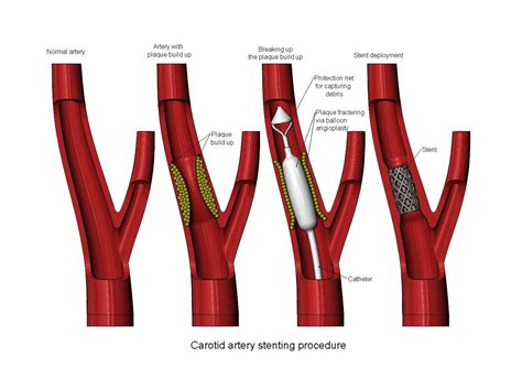 Carotid Artery Stenting Procedure Diorama - 3D Model by RachidSW