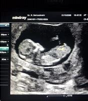 Accuracy of Ultrasonography in Fetal Gender Determination in 11 to 14 Week of Gestational Age ...