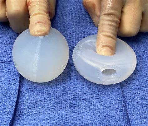 Plastic Surgery Case Study - Penoscrotal Webbing Correction with Combined Solid and Wraparound ...