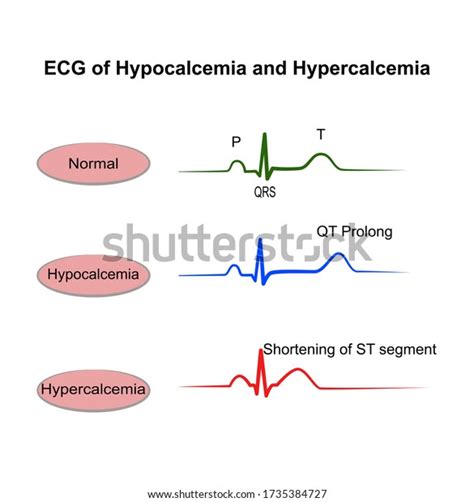 Hypocalcemia Ecg Changes