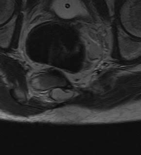 Sacral Agenesis-MRI - Sumer's Radiology Blog