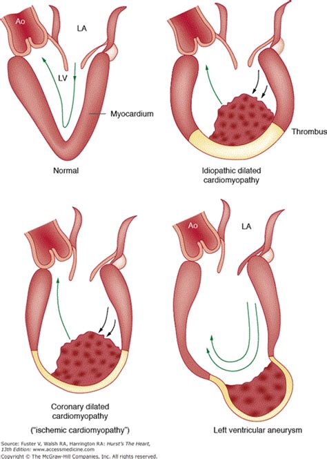 Nonatherosclerotic Coronary Heart Disease | Thoracic Key