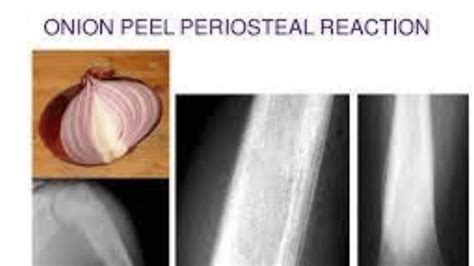 Know about onion skin periosteal reaction with Ewing sarcoma : Medical News Times