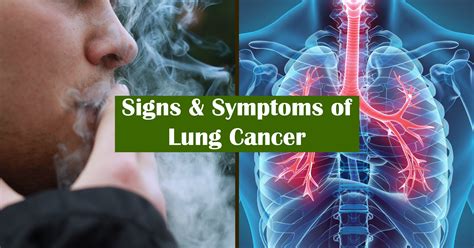 Signs and Symptoms of Lung Cancer - Merit Article